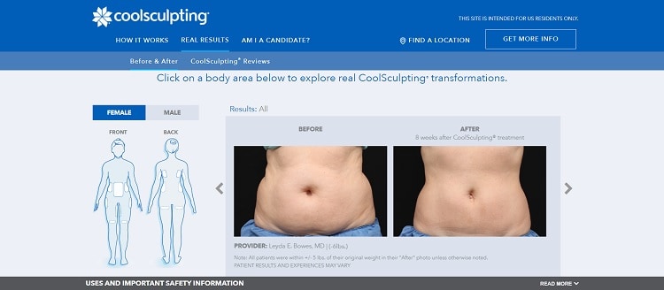 coolsculpting